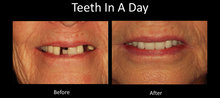 oral surgery procedures austin dental implant center